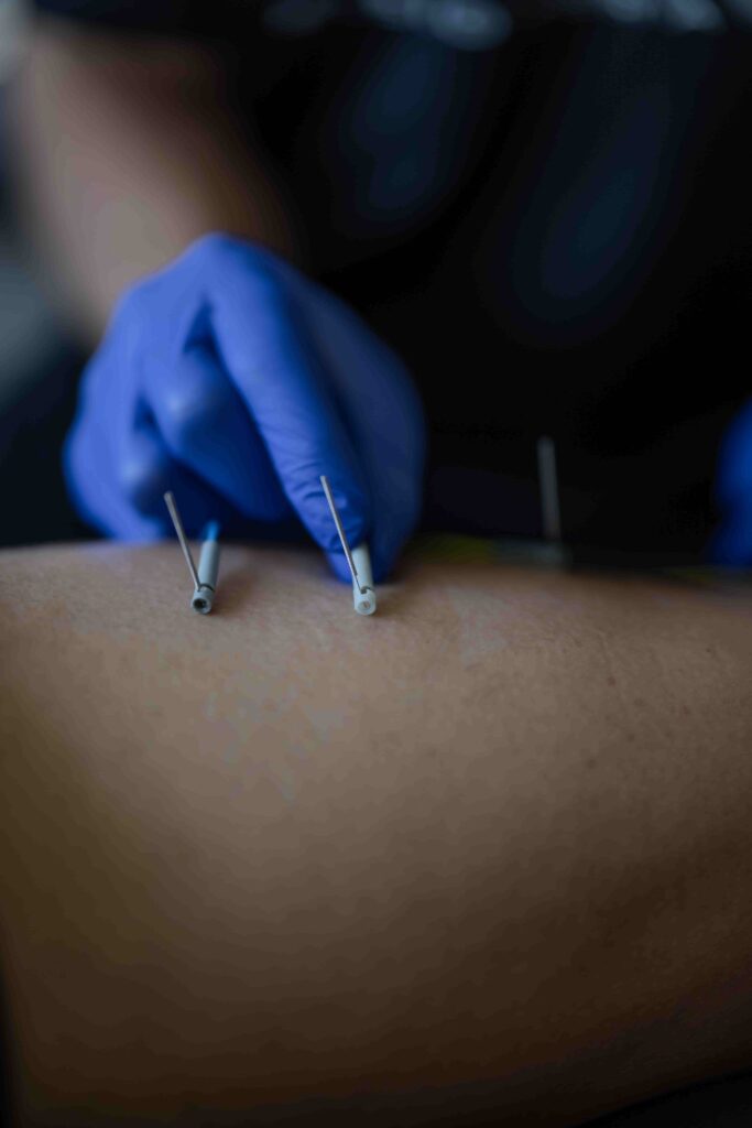 Fisioterapia Invasiva